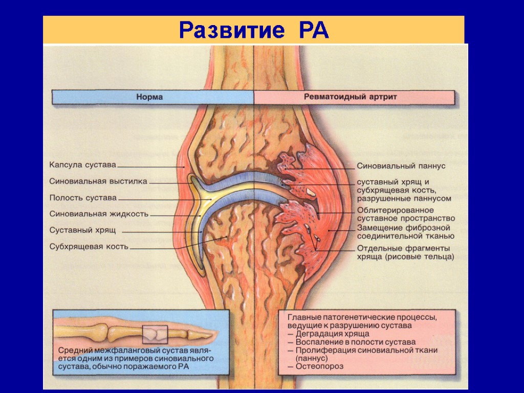 Развитие РА